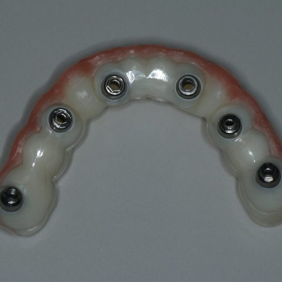 Occlusal view of a completed full-arch implant prosthesis