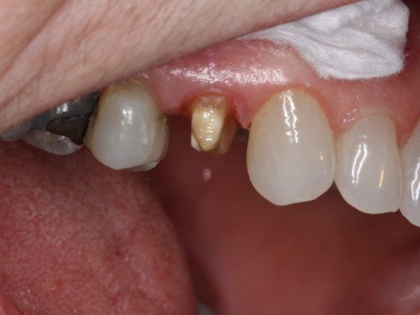 Prepared tooth ready for a custom crown restoration