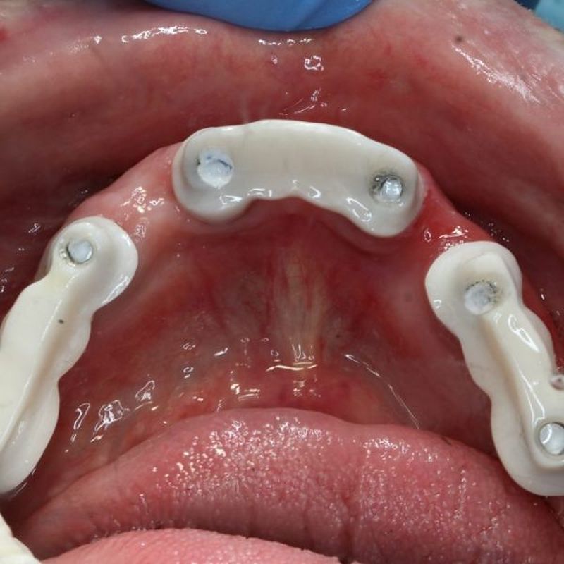 Clinical try-in of milled implant bar frameworks