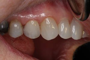 Porcelain fused to zirconia restoration